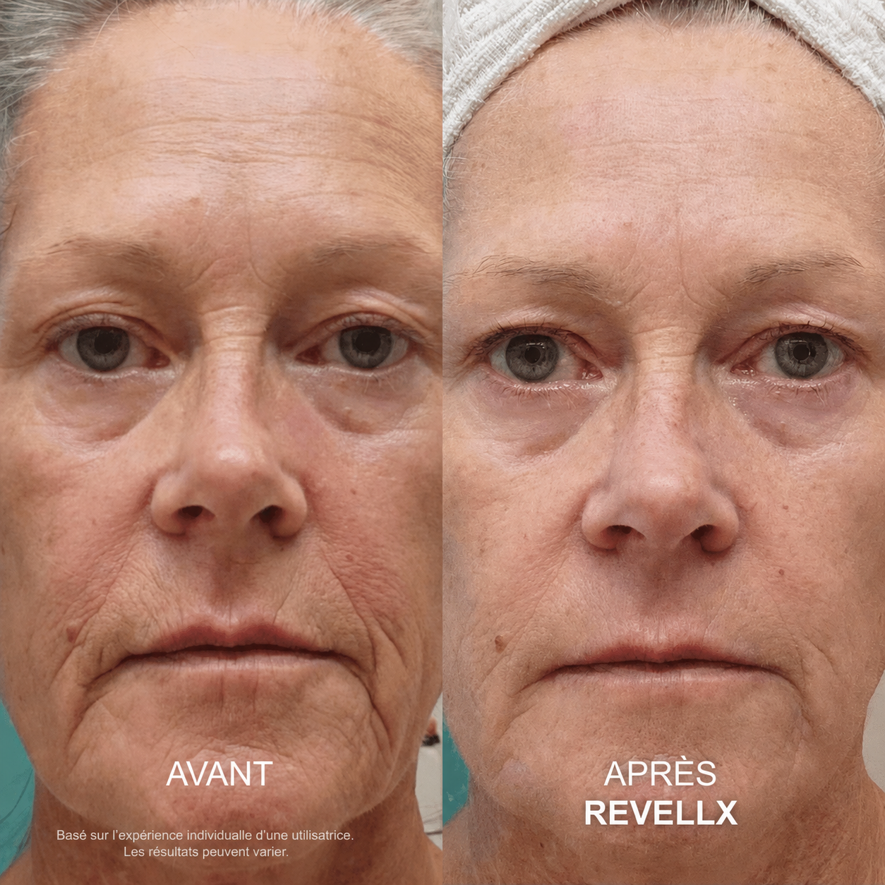 Revellx™ | Système de micro-infusion antige âge