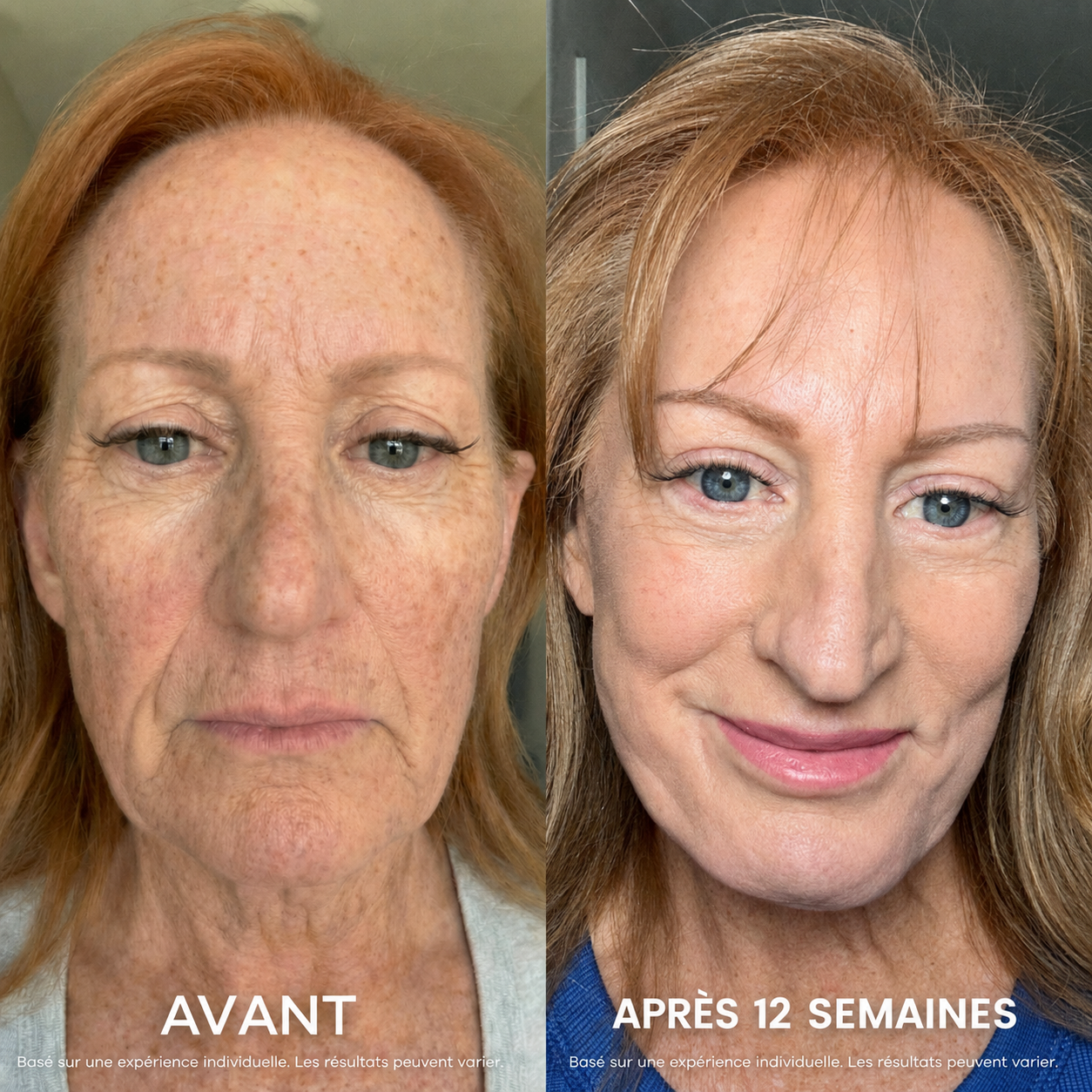 Revellx™ | Système de micro-infusion antige âge