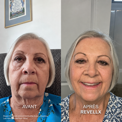 Revellx™ | Système de micro-infusion antige âge