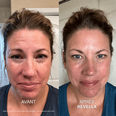 Revellx™ | Système de micro-infusion antige âge