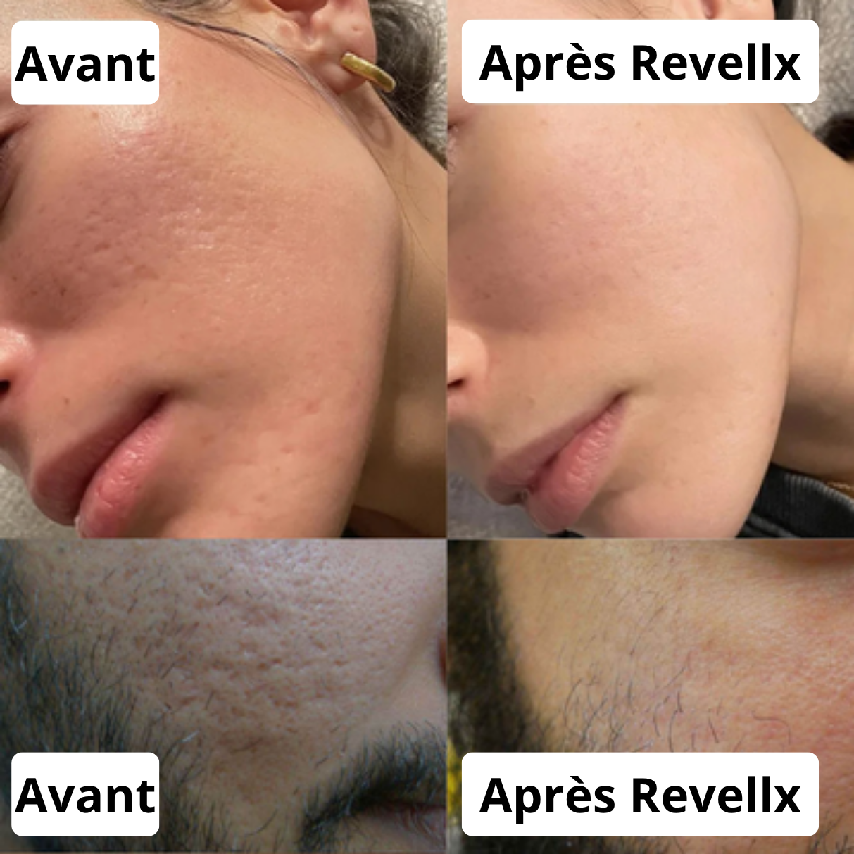 Revellx™ | Sérum Microneedling — Cicatrices d'acné