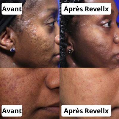 Revellx™ | Sérum Microneedling — Cicatrices d'acné