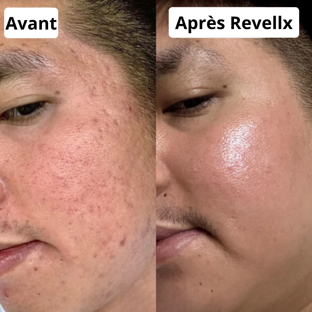 Revellx™ | Sérum Microneedling — Cicatrices d'acné