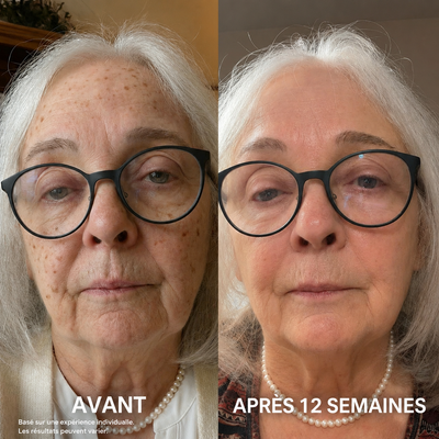 Revellx™ | Système de micro-infusion antige âge