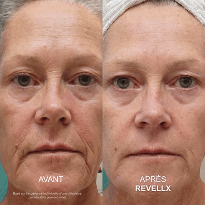 Revellx™ | Système de micro-infusion antige âge